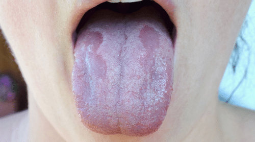 oral thrush sign of candida featured