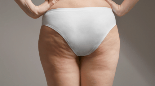 How to Get Rid of Cellulite on Thighs and Butt