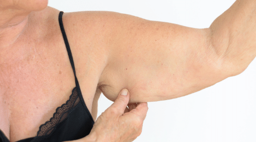 older woman's flabby arms featured