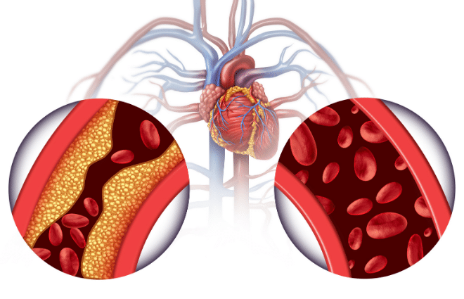 veins with cholesterol and without cholesterol