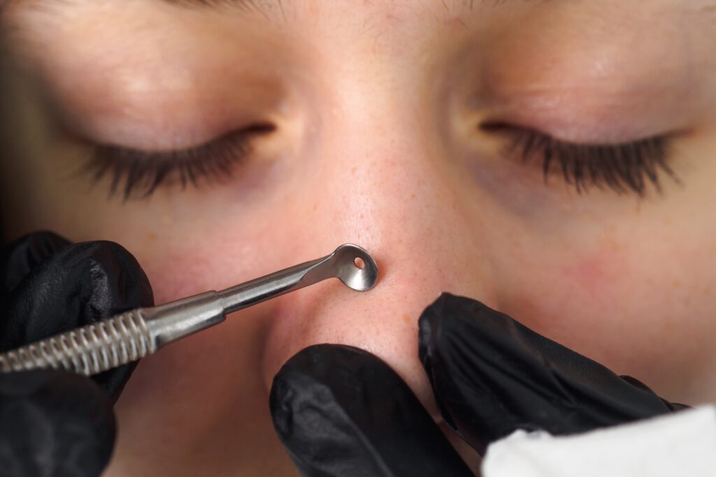 Pore extractor tool