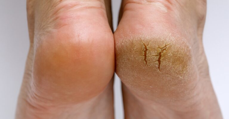 12 Natural Remedies to Repair Dry, Cracked Heels